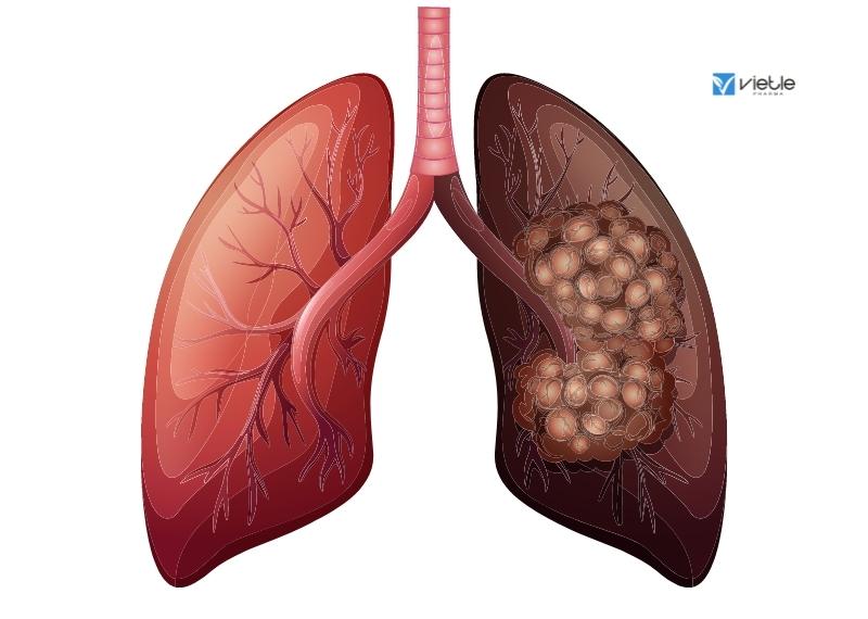 XẠ TRỊ UNG THƯ PHỔI
