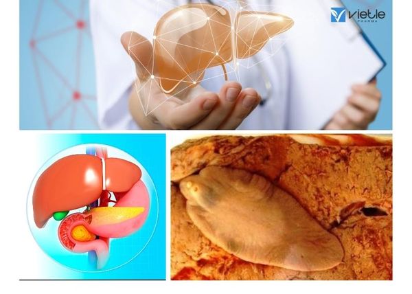 Áp xe gan do sán lá lớn