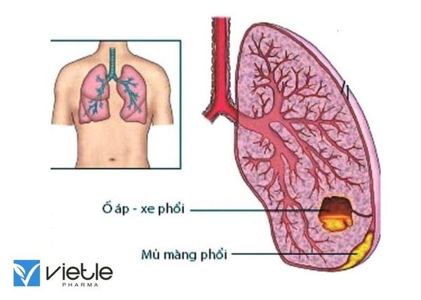 Áp xe phổi