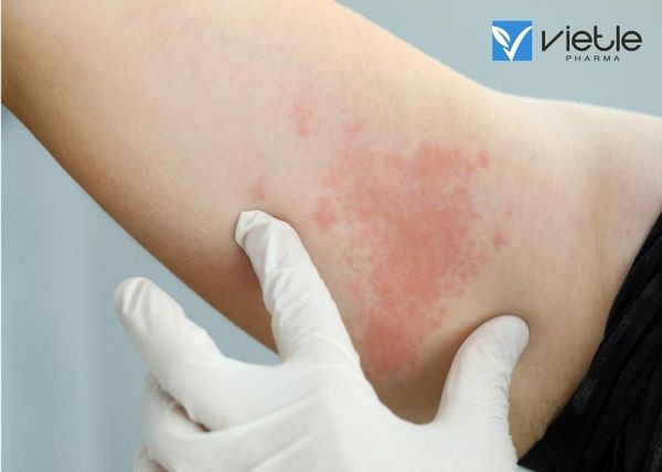 bệnh mày đay và những thông tin cần biết