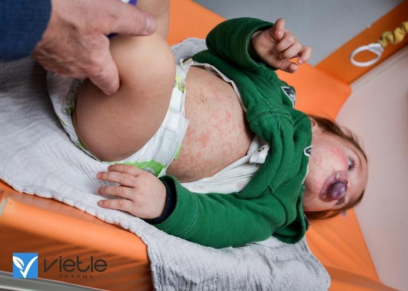 bệnh sởi ở trẻ em có nguy hiểm không?