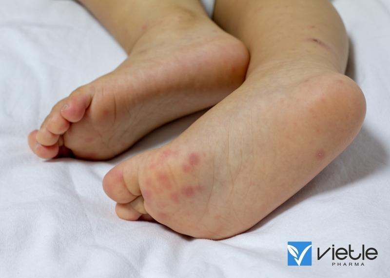 bệnh tay chân miệng ở trẻ em: dấu hiệu nhận biết