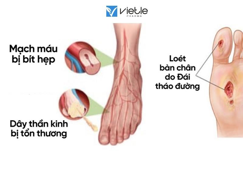 bệnh lý bàn chân do đái tháo đường