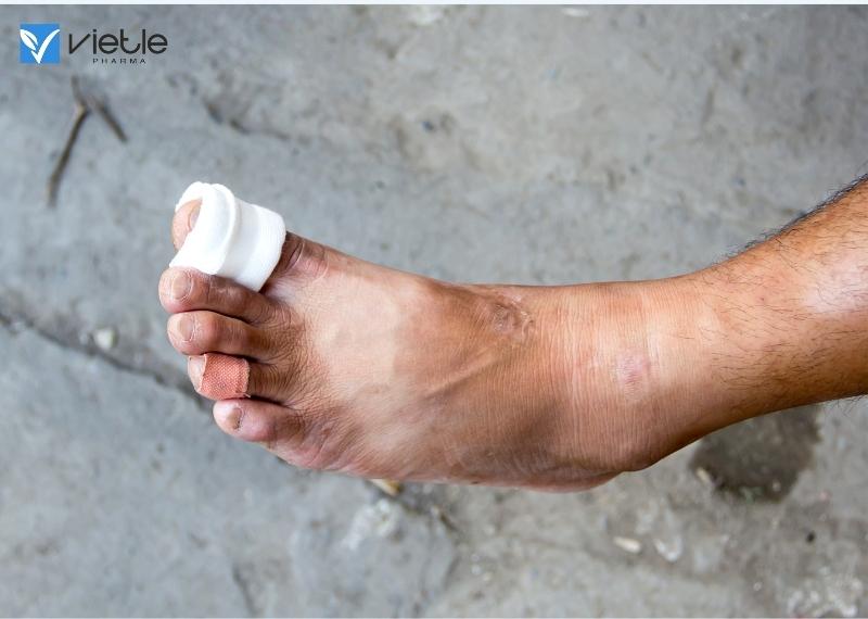 bệnh lý bàn chân do đái tháo đường
