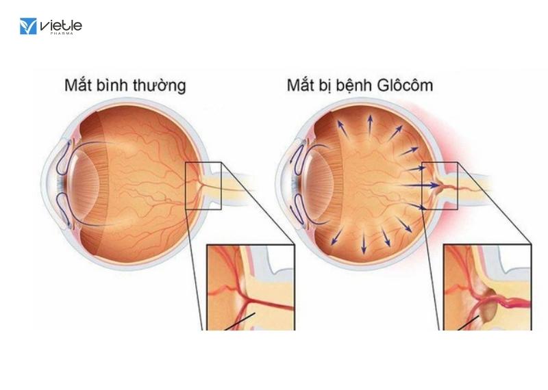 bệnh mắt ở người cao tuổi