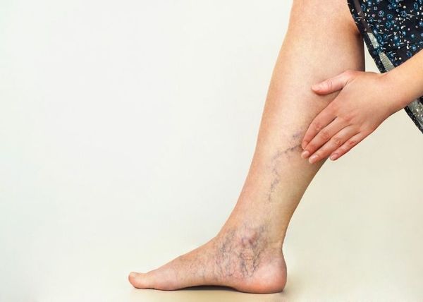 BỆNH TĨNH MẠCH MẠN TÍNH GIÃN TĨNH MẠCH VÀ SUY TĨNH MẠCH