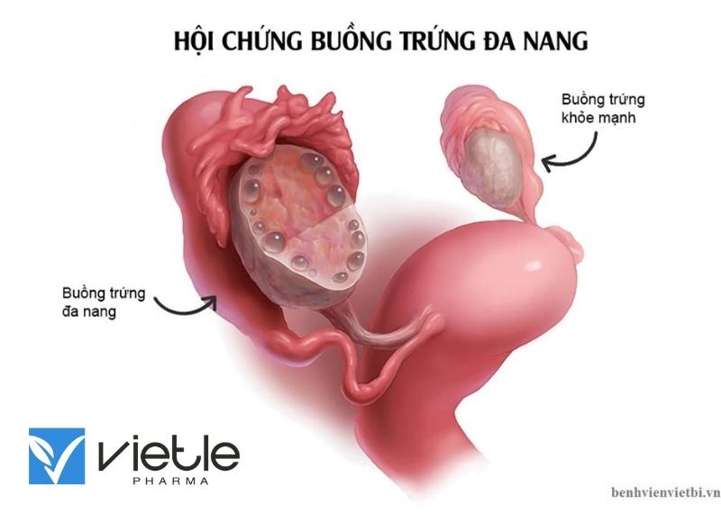 buồng trứng đa nang