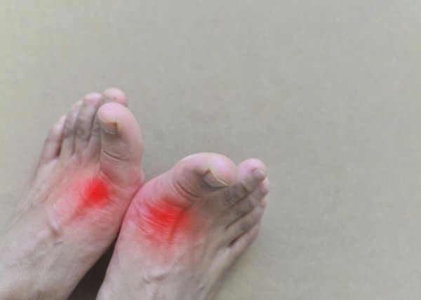 Chế độ ăn kiêng cho người bệnh gút: Nên và không nên ăn gì?