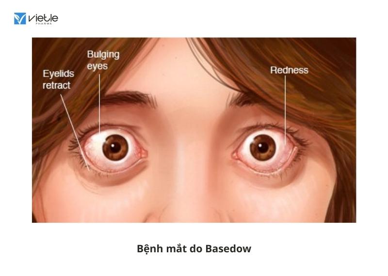 Cường chức năng tuyến giáp - bệnh Basedow