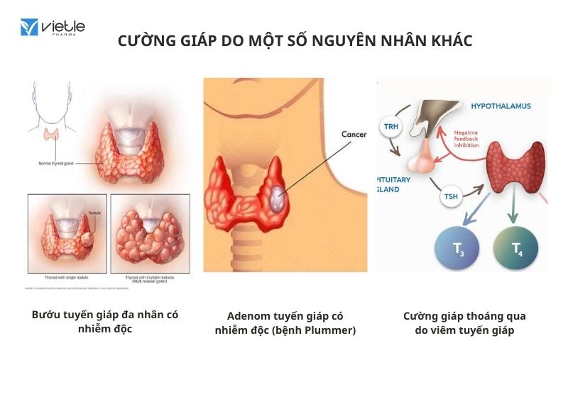 Cường chức năng tuyến giáp - bệnh Basedow