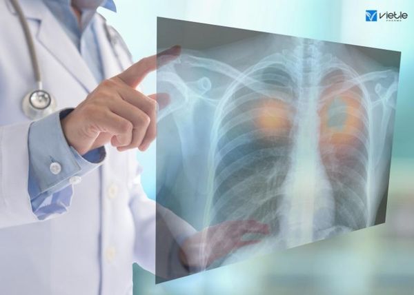 điều trị ung thư biểu mô màng phổi