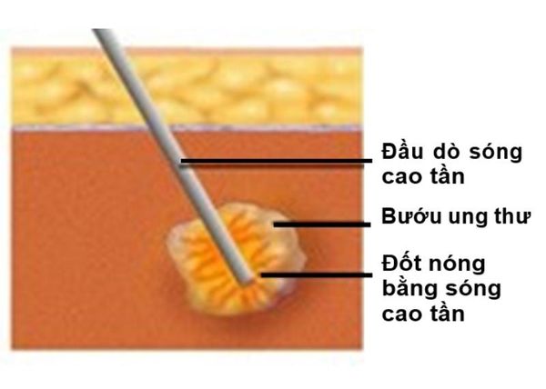 Đốt nóng các tế bào ung thư bằng sóng cao tần