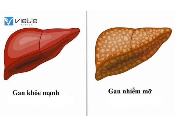 gan nhiễm mỡ