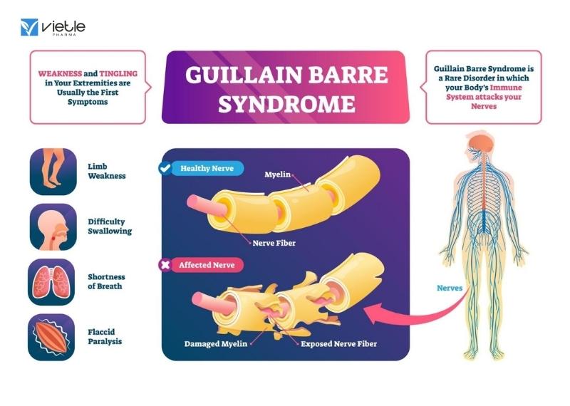 hội chứng Guillain - Barré