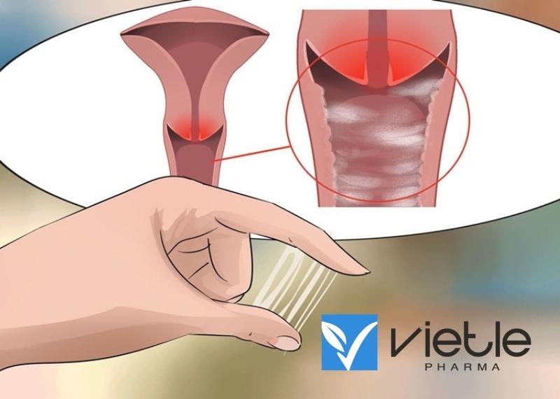 huyết trắng do vi khuẩn
