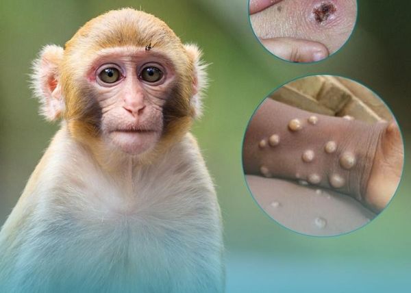 Nóng Bộ Y tế ban hành hướng dẫn chẩn đoán, điều trị và phòng bệnh đậu mùa khỉ ở người