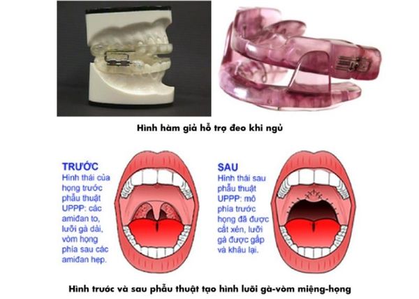 ngưng thở khi ngủ