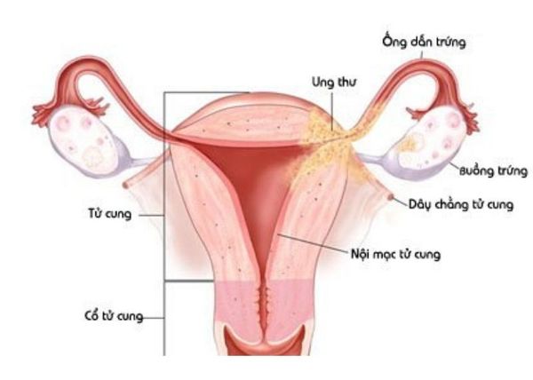 NHIỄM KHUẨN HẬU SẢN