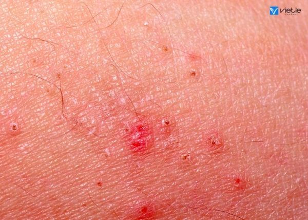 nhiễm trùng ở da và mô mềm là gì