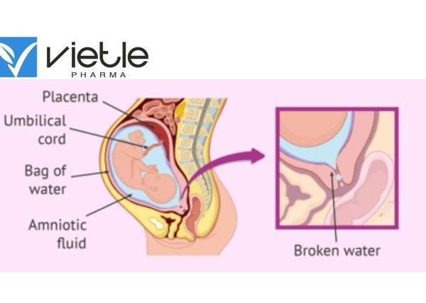 Ối vỡ sớm ối vỡ non