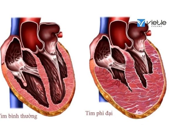 phì đại thất trái