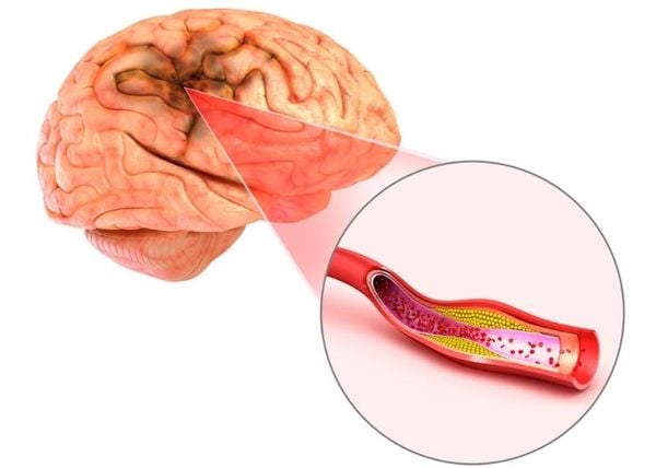 Phòng ngừa đột quỵ não phải đúng cách mới hiệu quả