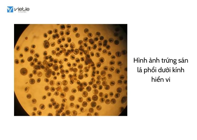 sán lá phổi