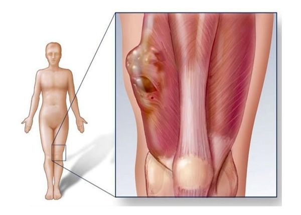 sarcoma cơ vân