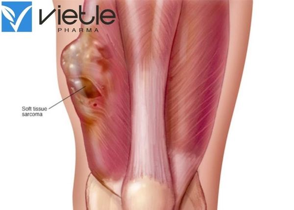 Sarcoma mô mềm