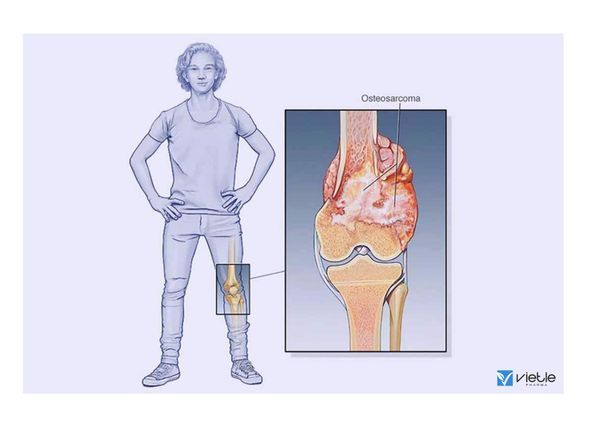 sarcoma xương