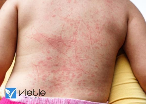 Sốt xuất huyết Dengue