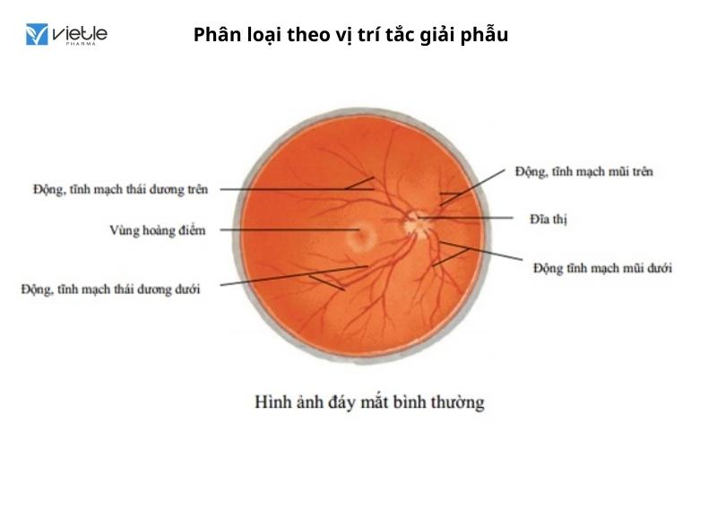 Tắc tĩnh mạch võng mạc