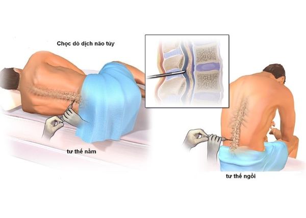 TĂNG LACTATE MÁU TRONG CÁC RỐI LOẠN CHUYỂN HÓA BẨM SINH