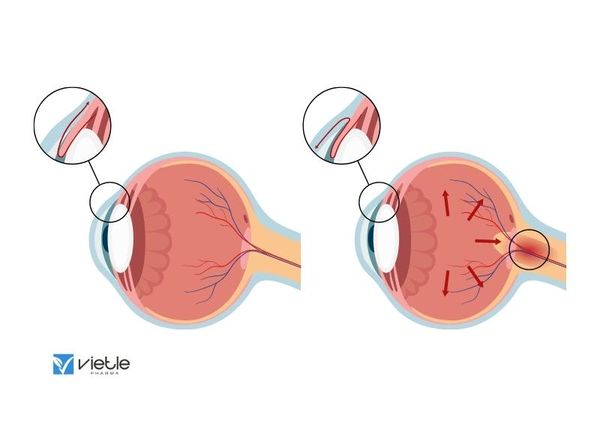 Tăng nhãn áp sau chấn thương đụng dập