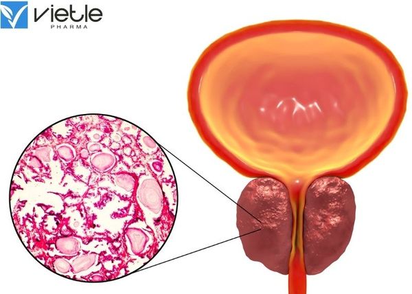 Tăng sản tuyến tiền liệt lành tính