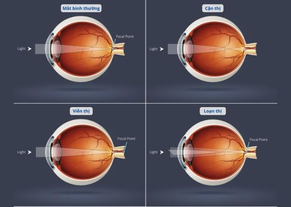 Tật khúc xạ học đường - Nỗi lo mỗi mùa khai giảng