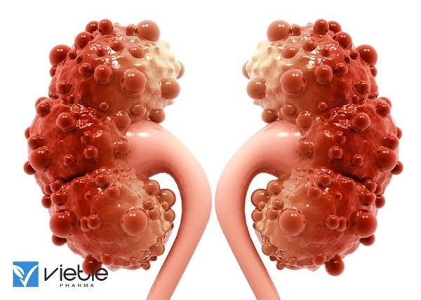 thận đa nang: nguyên nhân và triệu chứng