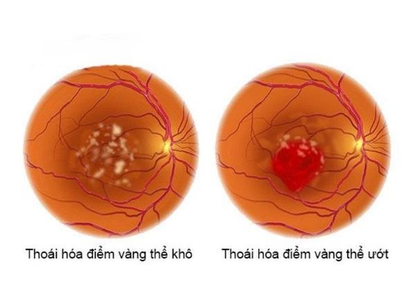 thoái hóa điểm vàng