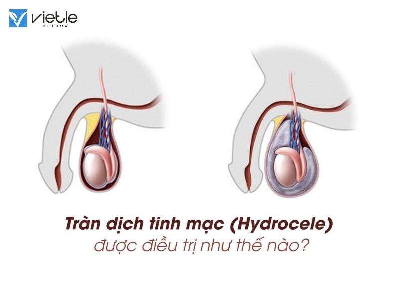 tràn dịch tinh mạc và những điều cần biết
