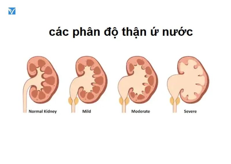 Ứ NƯỚC Ứ MỦ BỂ THẬN