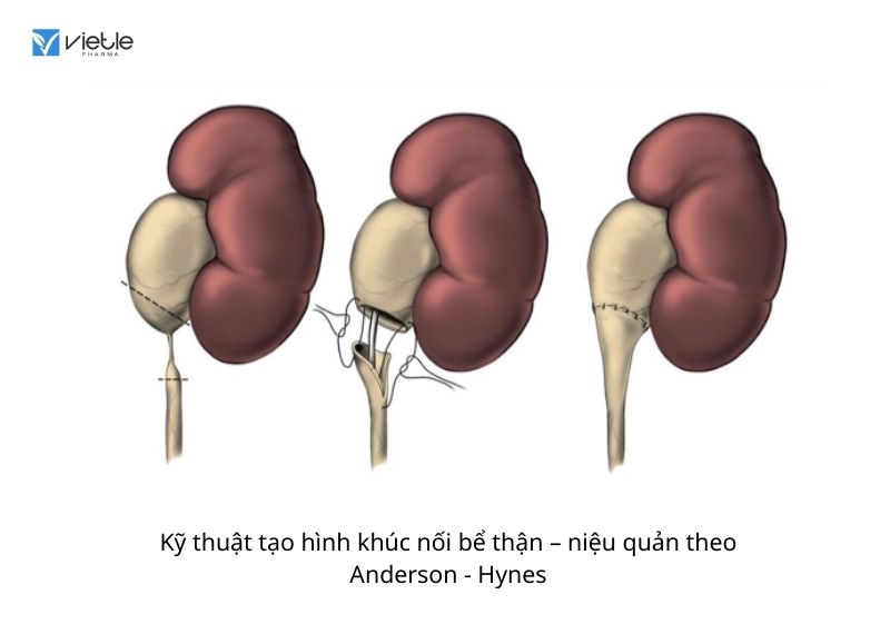 Ứ NƯỚC Ứ MỦ BỂ THẬN