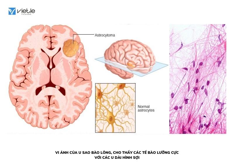U thần kinh đệm trẻ em