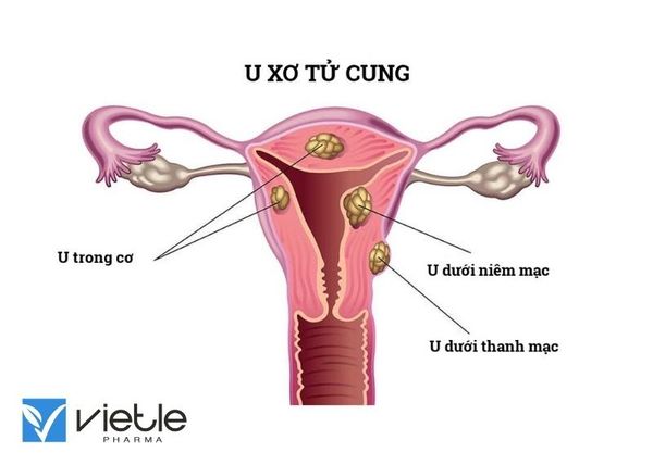 U XƠ TỬ CUNG