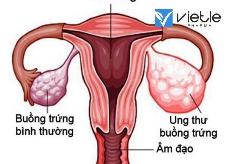 ung thư buồng trứng