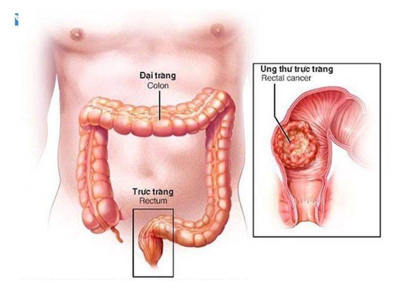 ung thư đại trực tràng