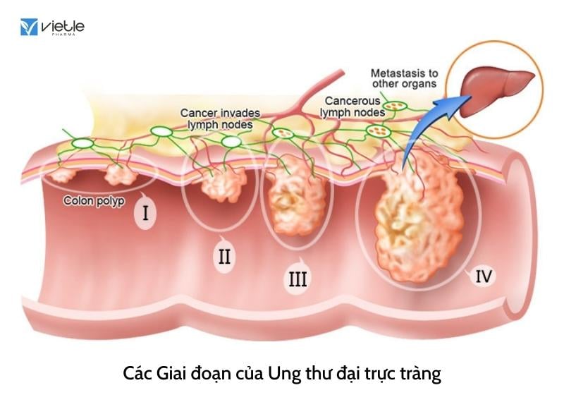 ung thư đại trực tràng