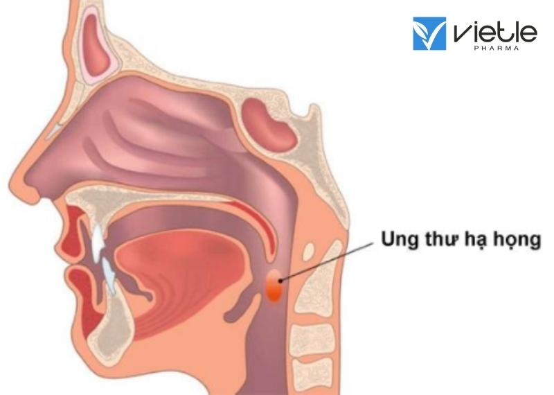 UNG THƯ HẠ HỌNG