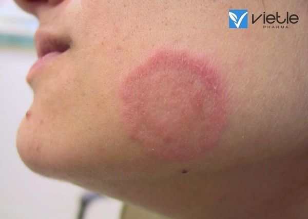 vảy phấn hồng gibert và những thông tin cần biết