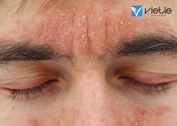 viêm da dầu: triệu chứng và điều trị