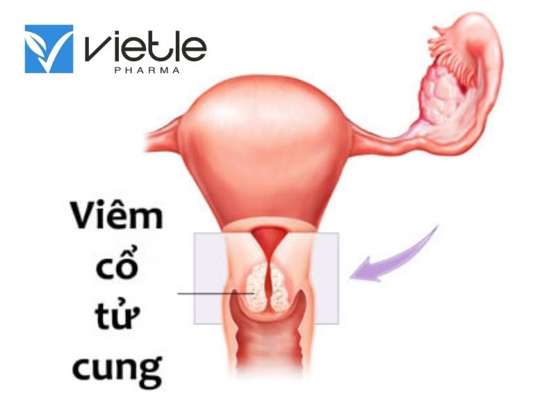 viêm cổ tử cung